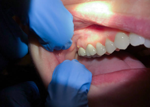 Best Emergency Treatment for Dental Infections or Abscesses in Garberville, CA