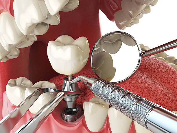 Best Emergency Tooth Extraction in Garberville, CA